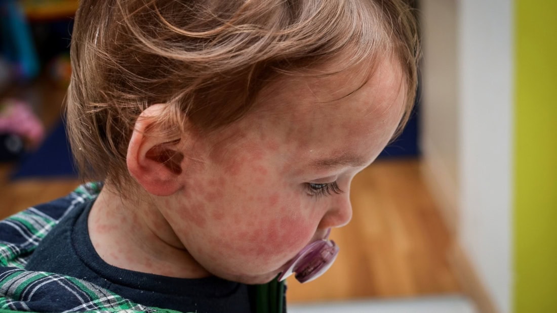 Huiduitslag en koorts bij een kind met mazelen, gezondheidszorg en vaccinatie.